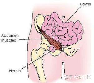 股疝手术步骤图片