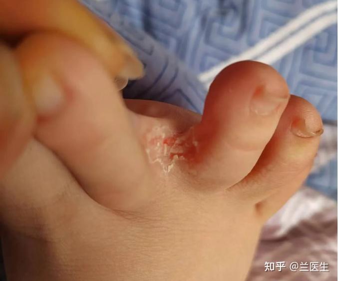 还有一点需要注意,真菌十分顽固,穿过