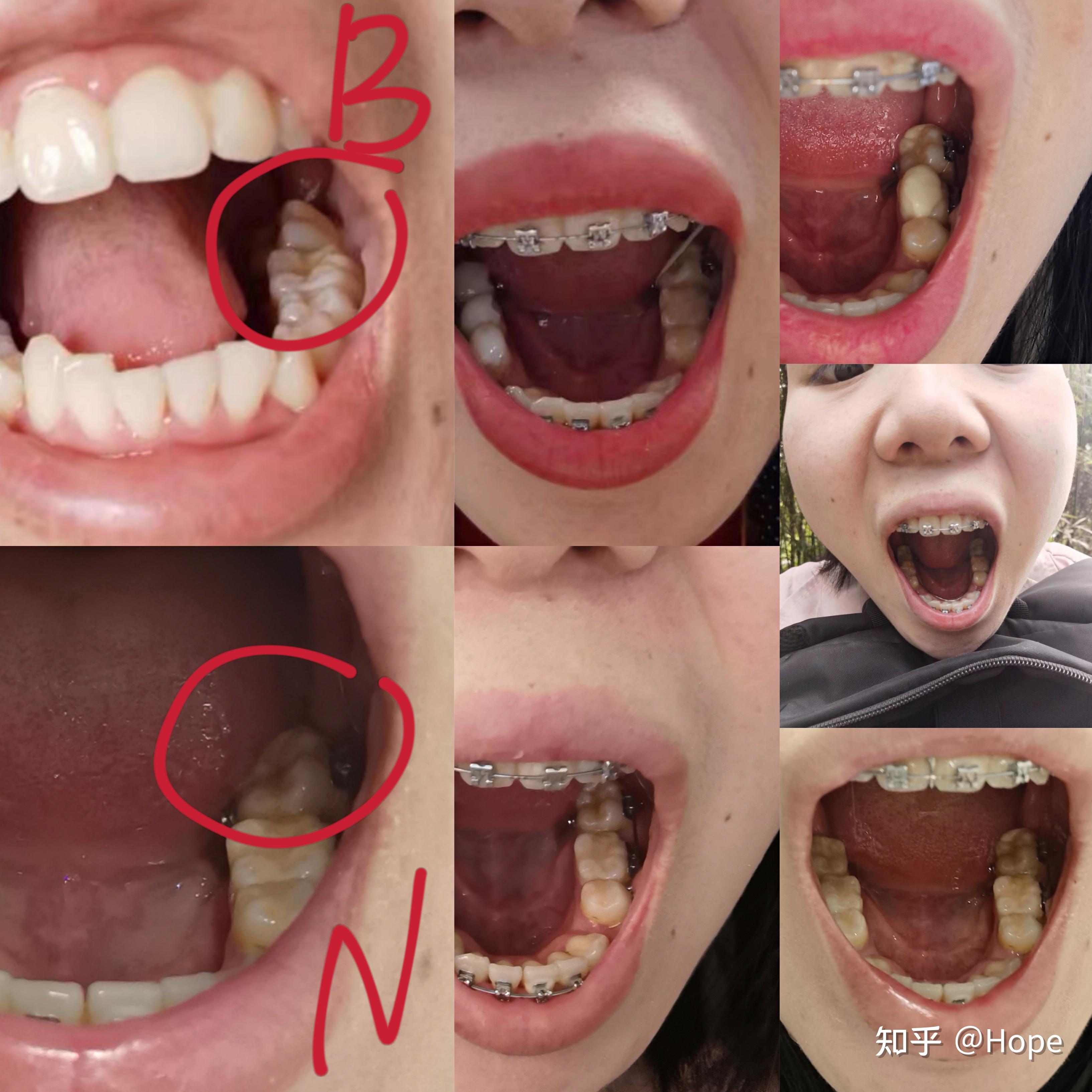 一个25岁的姐姐亲身体验告诉你,25岁正畸啥感觉