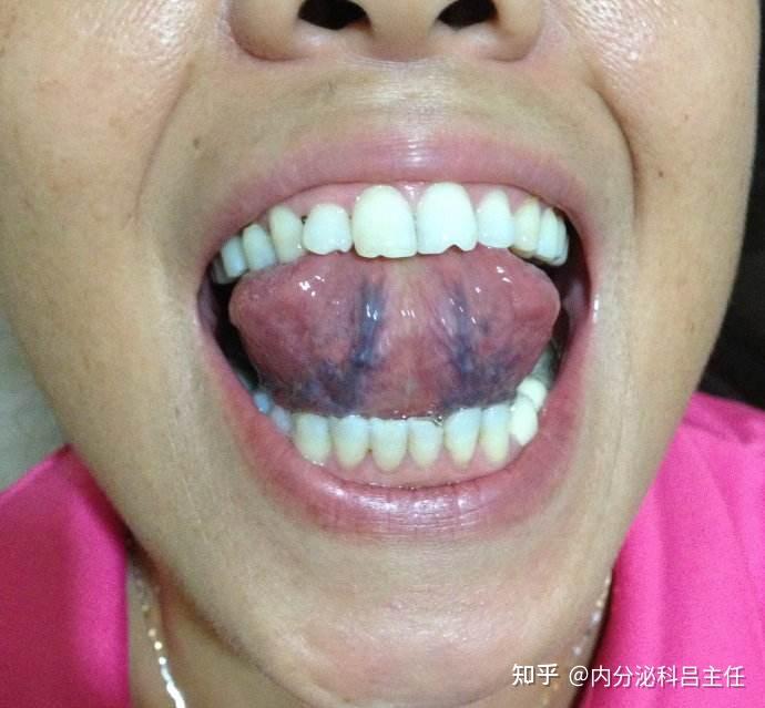 提醒：舌头下面两根筋，颜色变黑要当心！ - 知乎