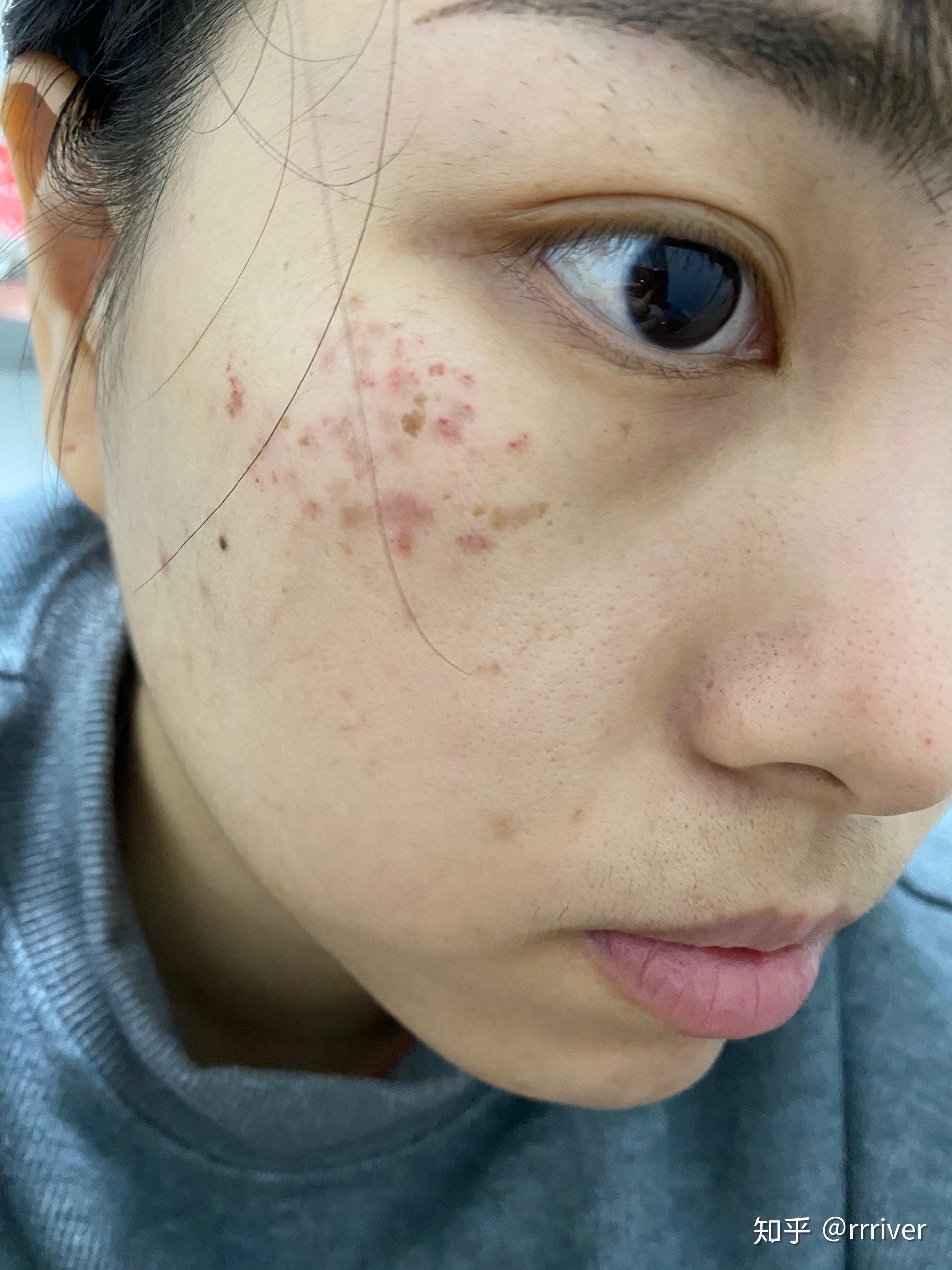 有谁褐青色痣治好过? - 知乎