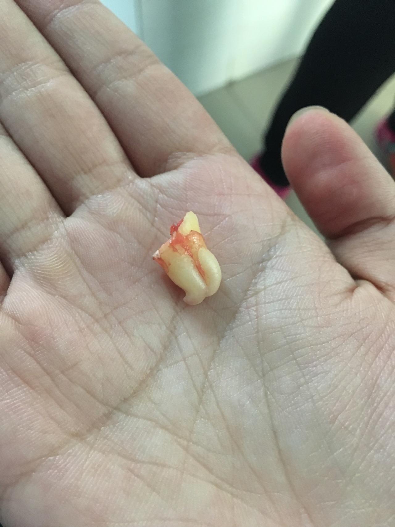 拔智齿有多痛? - 知乎