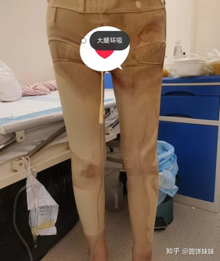 成都大腿吸脂