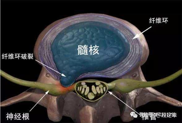 椎间盘突出与腰肌劳损