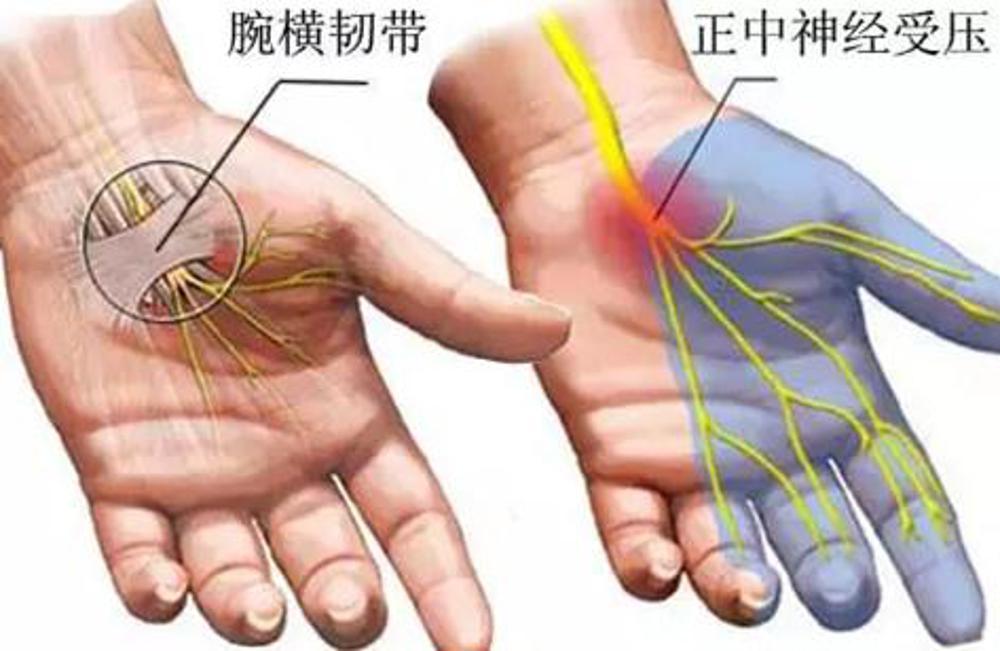 手指麻木,手部肌肉萎缩可能是这个原因(腕管综合征是什么病?