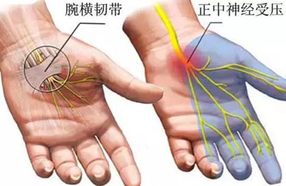 手指麻木 手部肌肉萎缩可能是这个原因 腕管综合征是什么病 知乎