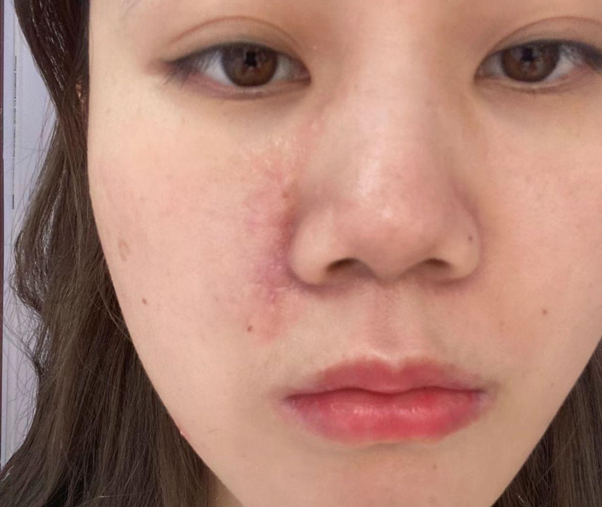 脸上有疤痕怎么办最快消除（脸上痘印痘疤是怎么形成的？如何快速的祛除？如何预防？） | 说明书网