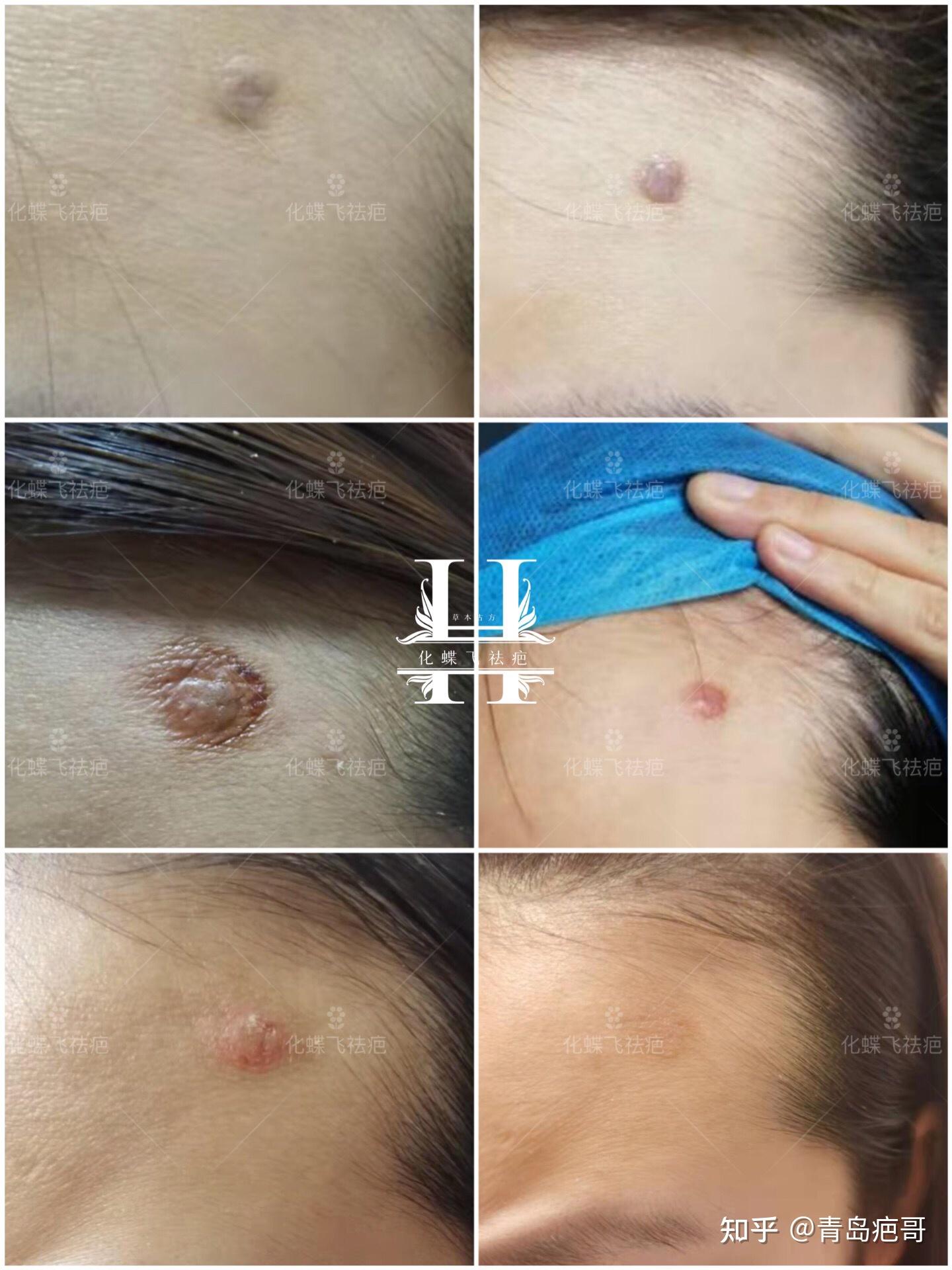 疾控中心抗疫三年的英雄,但是手太欠了 涂中药#祛疤,期间老是抠结痂