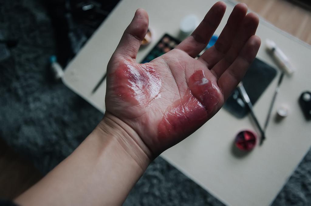 需要什么样的药物化学物质能在皮肤上弄出这样的泡