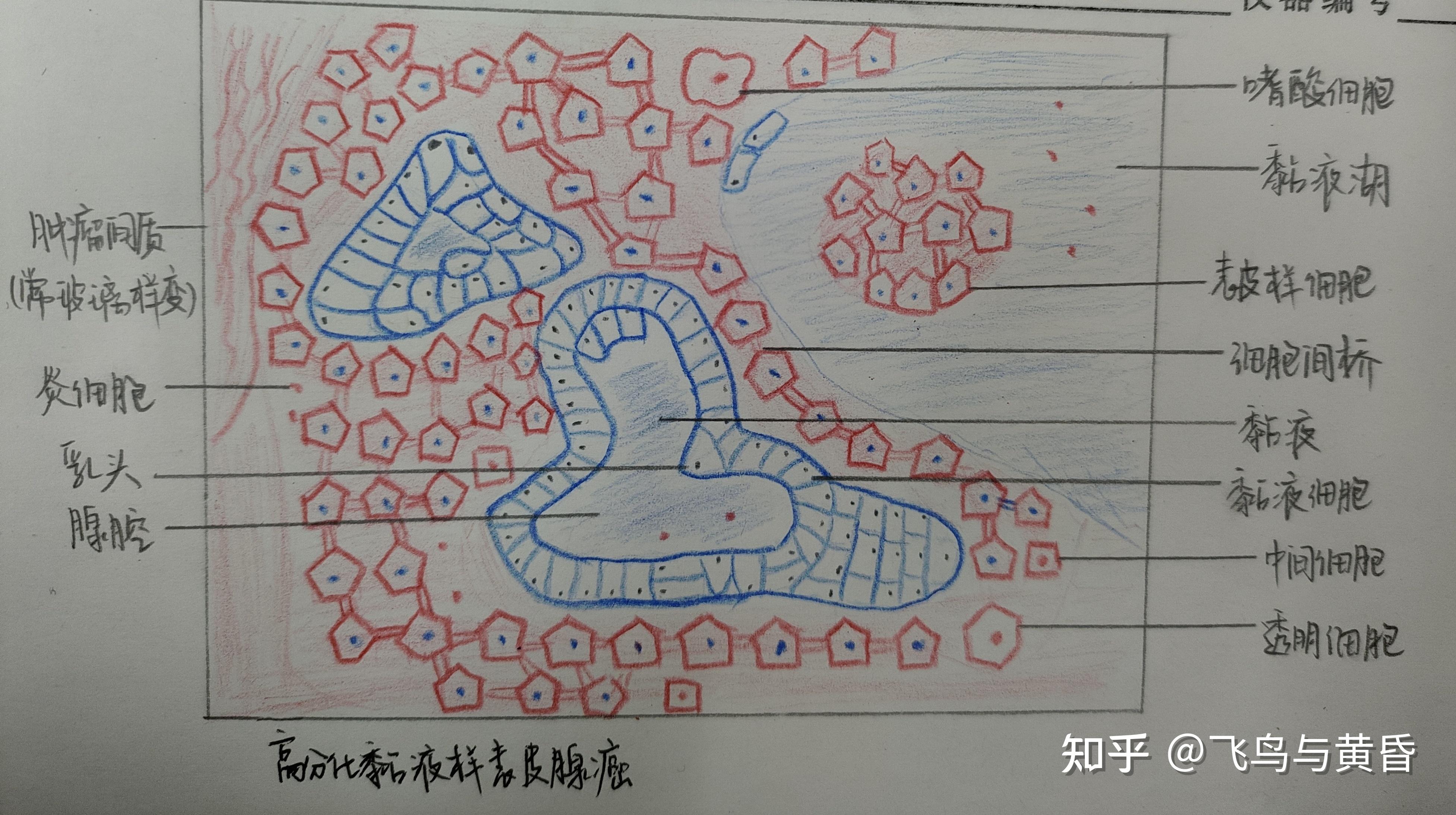 高分化粘液样表皮腺癌的红蓝铅笔图