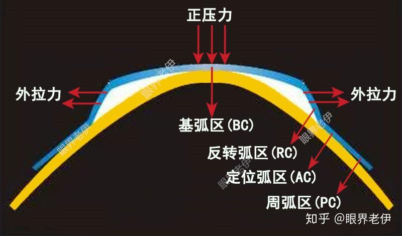 角膜塑形镜在美国被禁止是真的吗?求权威