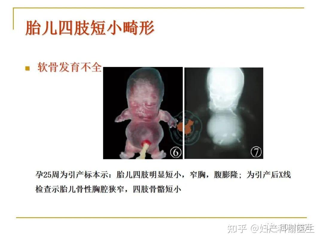 78岁珠海老人膝关节畸形成K型腿 AI+3D打印技术助力复原