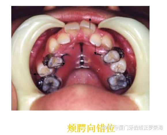 厦门牙齿矫正口腔正畸学入门