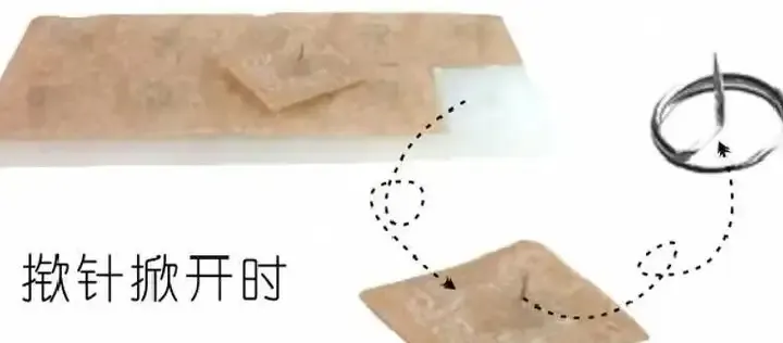 中医揿针真的有用吗？一文带你了解中医特色疗法揿针！ - 知乎