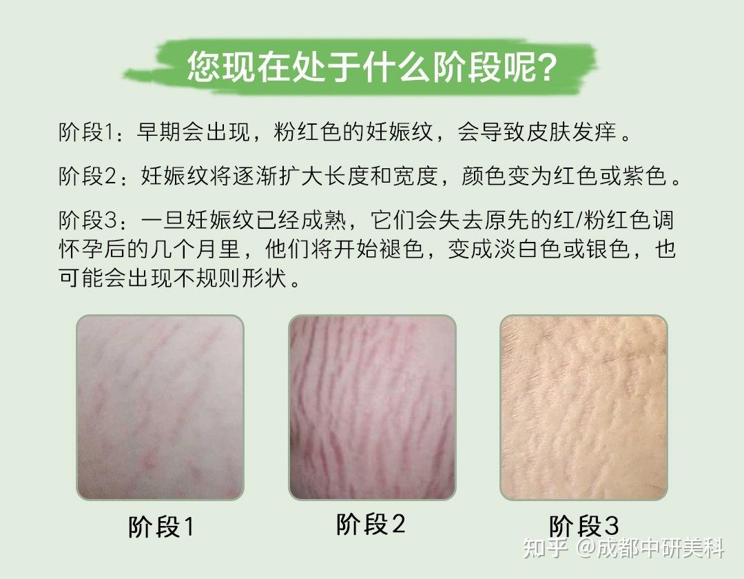 妊娠纹形成4年了可以去除吗