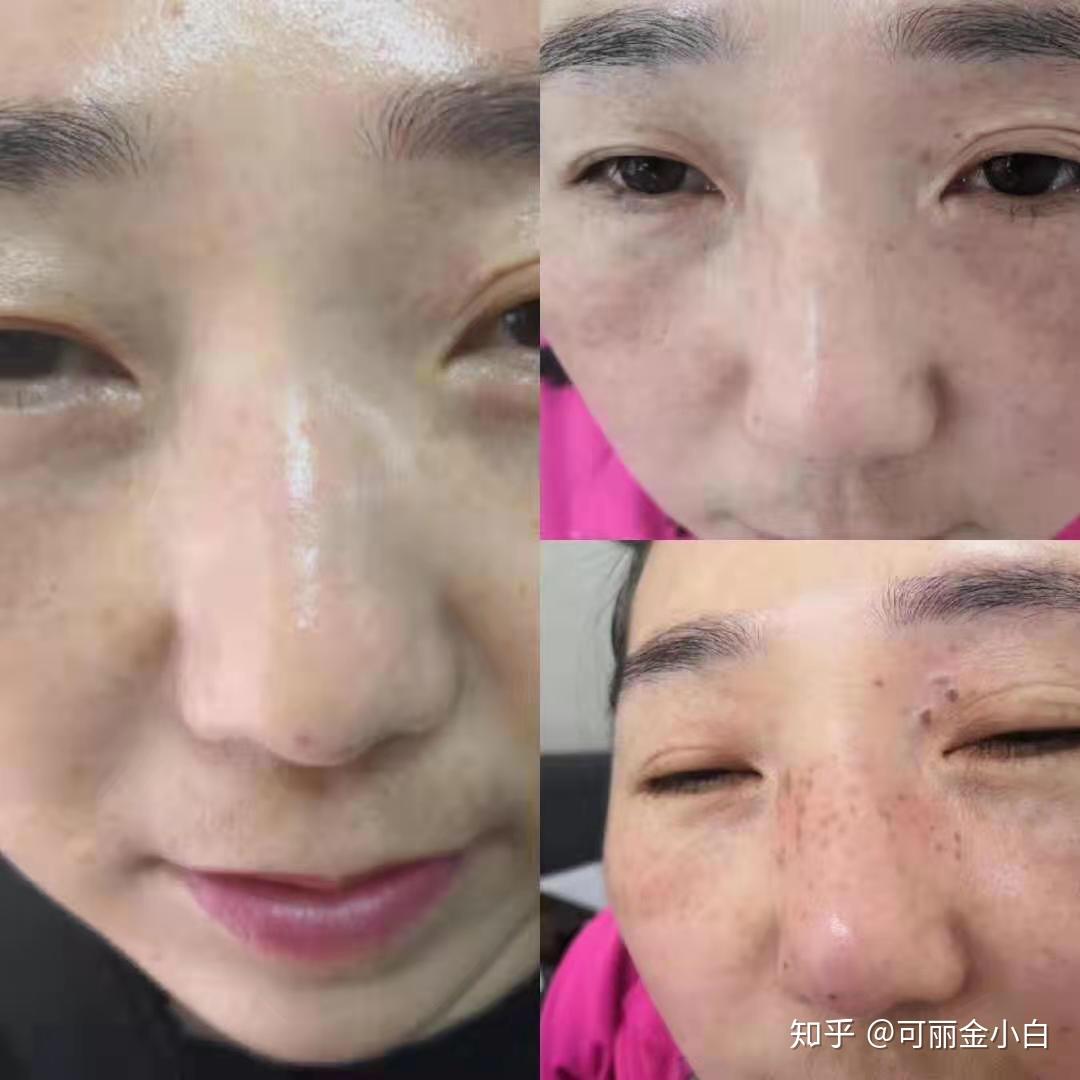 千白氢醌乳膏可以淡化雀斑吗