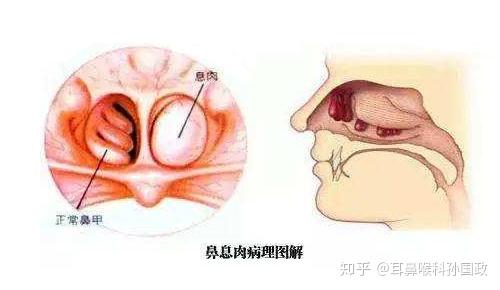 耳鼻喉科孙国政科普鼻息肉鼻息肉的病因是什么