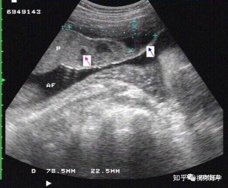 膜状胎盘超声图片图片