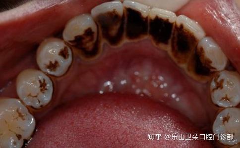 2:是在牙齿发育过程中形成的,如四环素沉积在牙本质内,就会使得牙齿