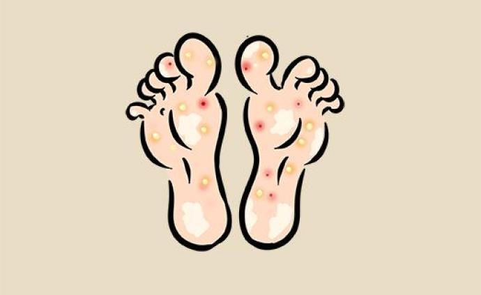 在对两足一手型手足癣流行病床,临床病历分析以及菌种分布等研究中