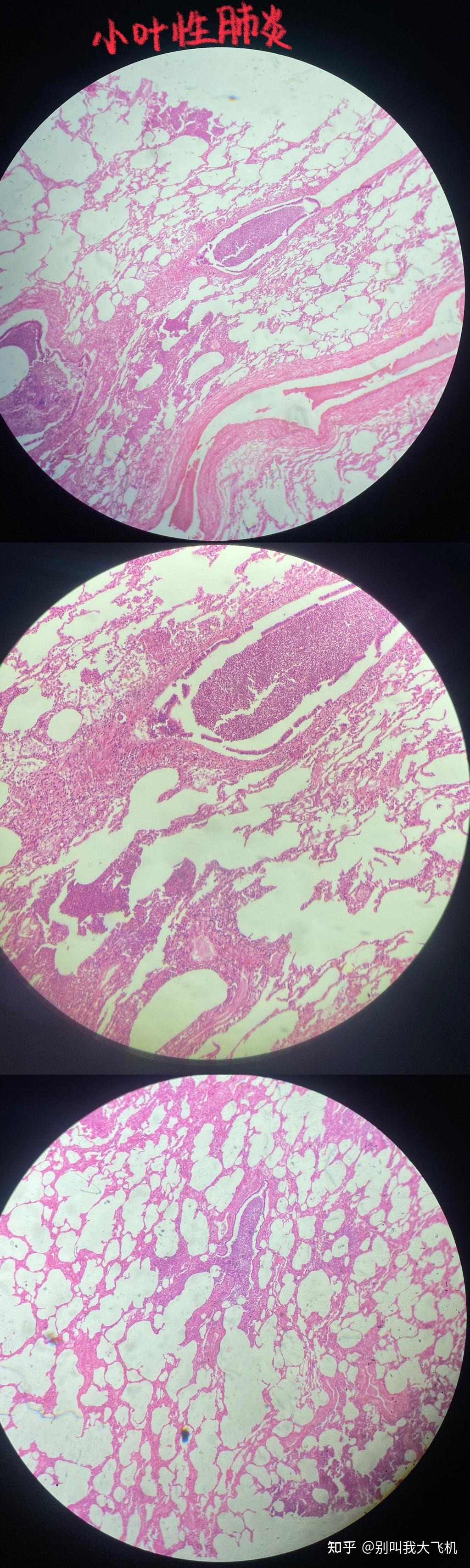 病理实验切片红蓝铅笔绘图