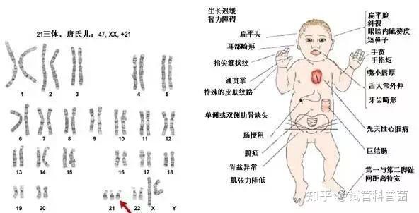 唐筛无创dna羊水穿刺该怎么选择