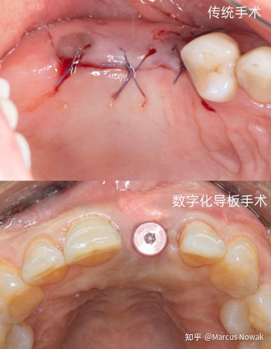 牙齿手术照片图片