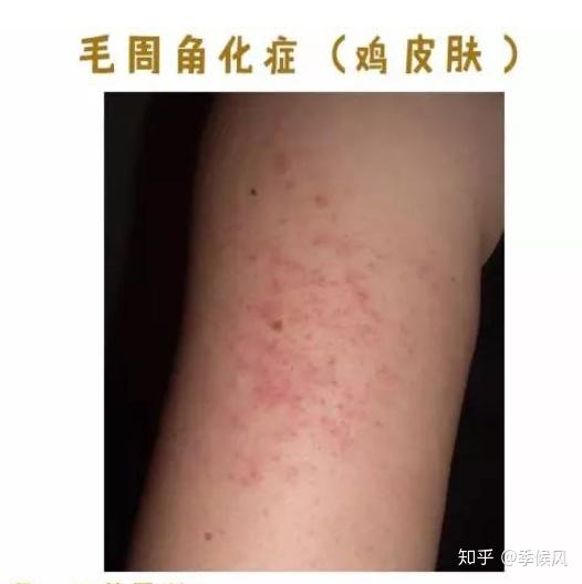 为什么长鸡皮肤了(为什么我身上的鸡皮肤今年又长了很多)