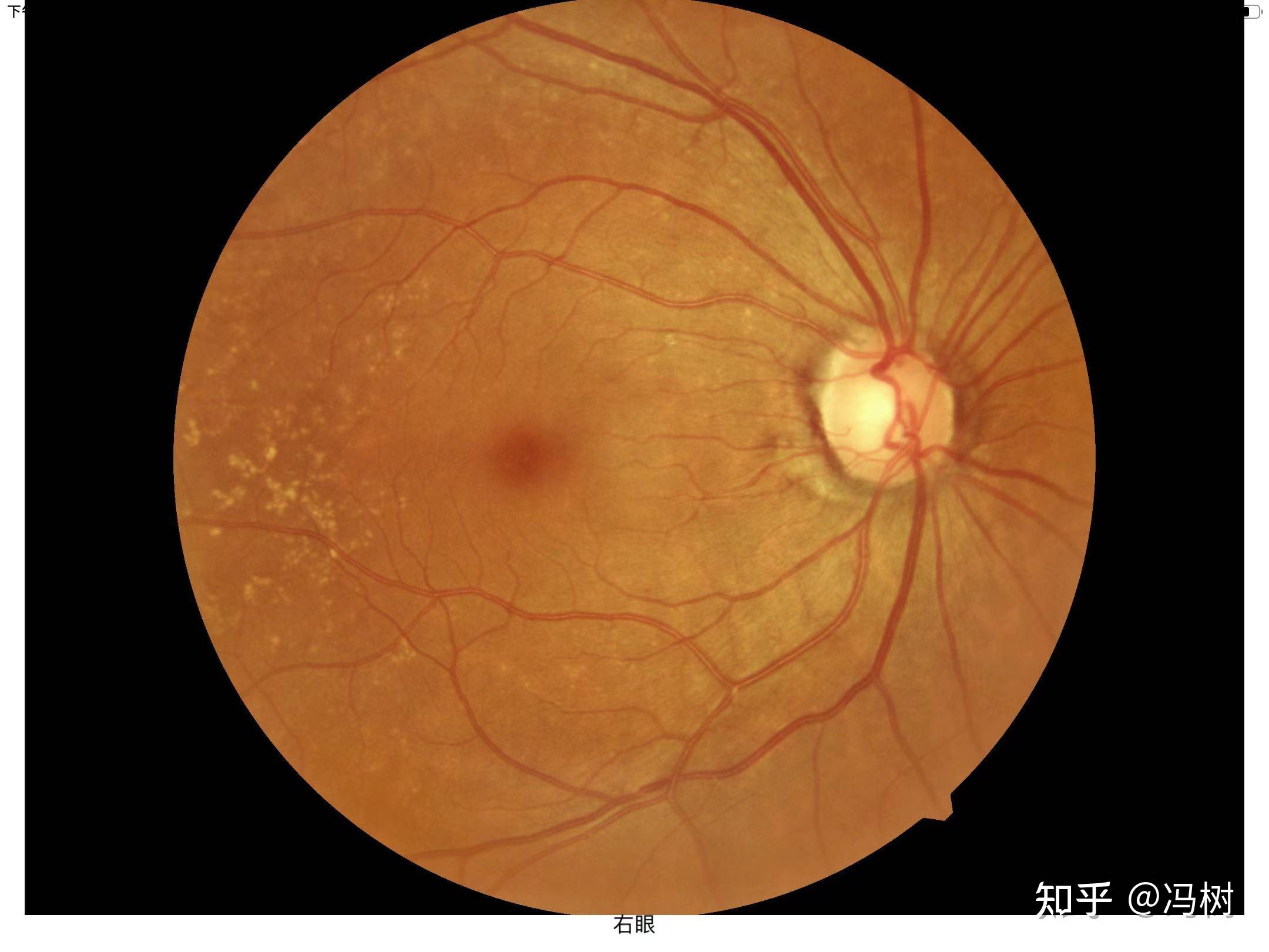 眼底一张图,健康全知道