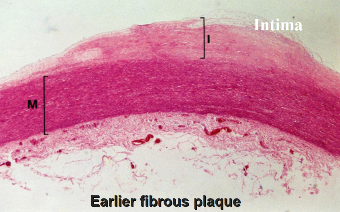 动脉粥样硬化纤维帽图片