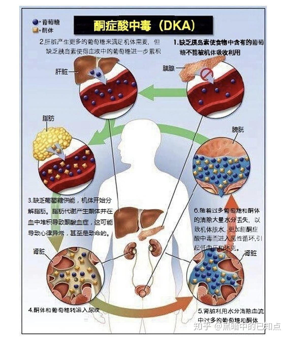 什么是糖尿病?看这一篇就够了 - 知乎