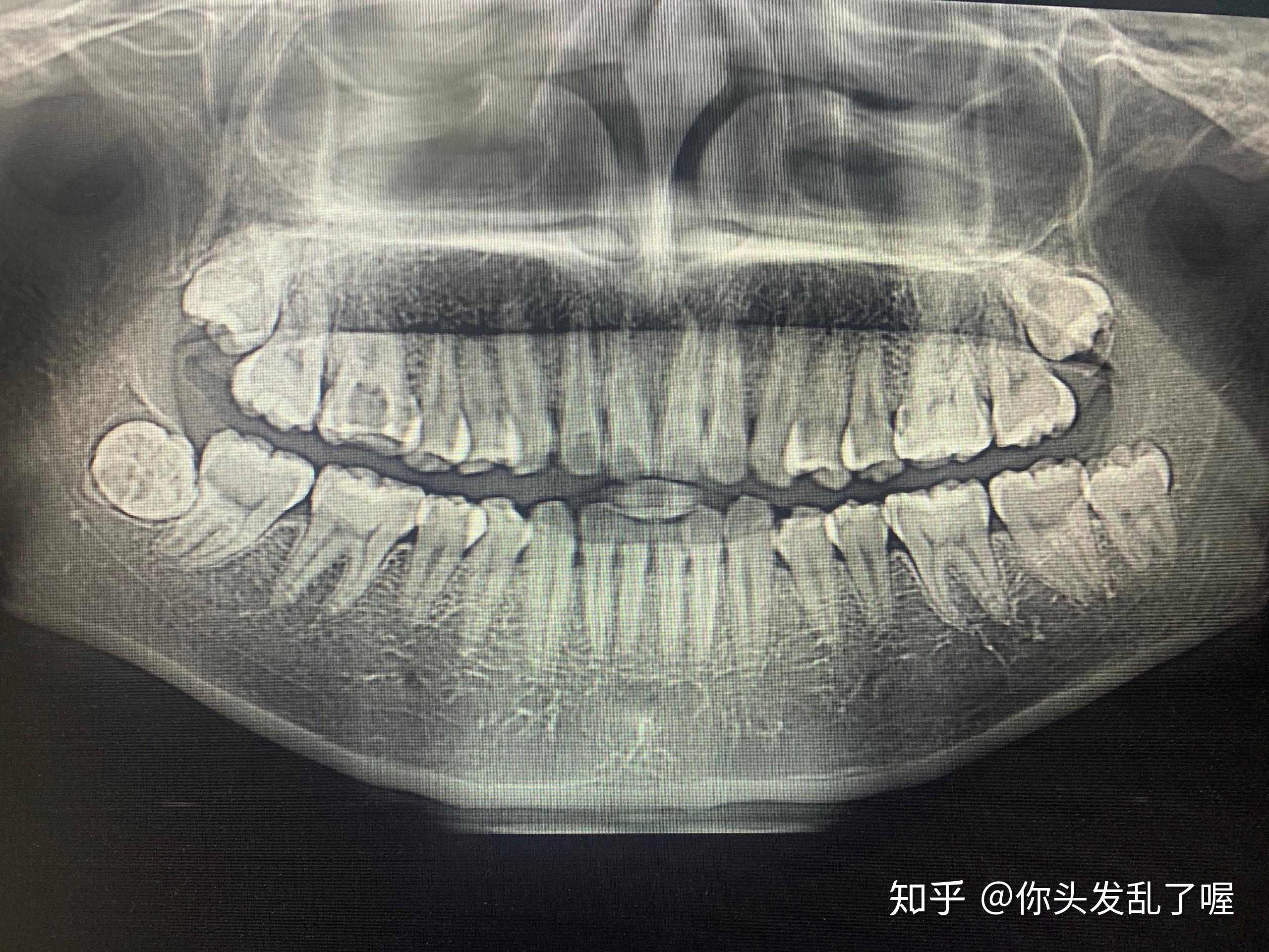 想問一下你們壓到神經的智齒多少錢拔的有沒有什麼後遺症