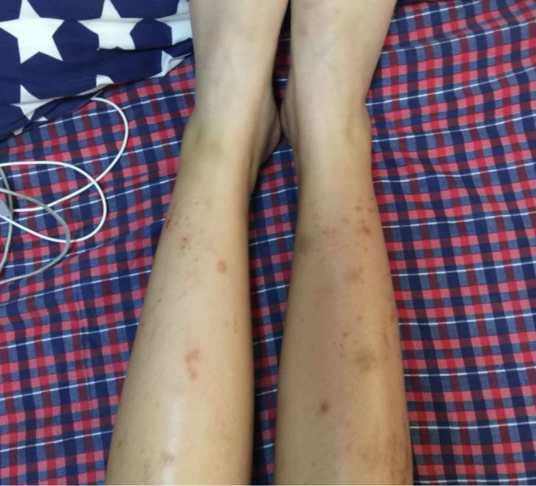 湿疹图片初期症状图片看图了解腿部湿疹如何治疗