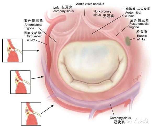 瓣膜病—二尖瓣关闭不全 - 知乎