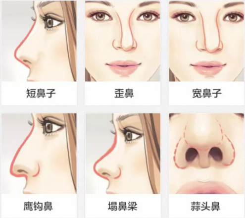 想要隆鼻直鼻水滴鼻和小翘鼻哪种最好看怎么选择合适的隆鼻材料