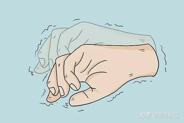 颤抖的手不只是帕金森病警惕特发性震颤