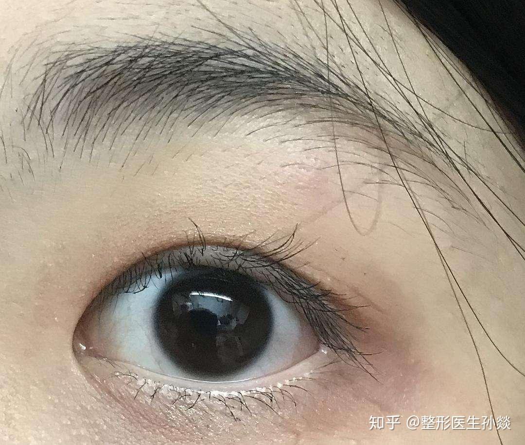 内眦开大(内眼角)