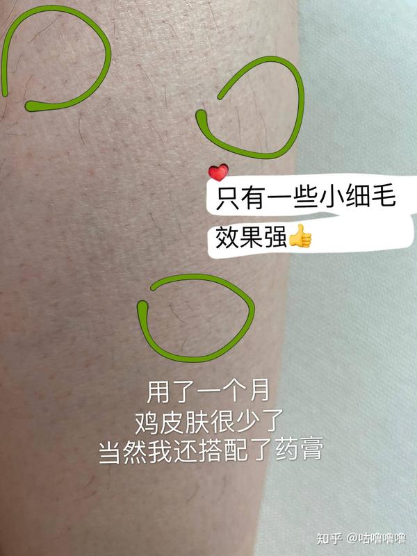 鸡皮肤长出毛能用脱毛仪吗(有鸡皮肤的人可以用脱毛仪吗)