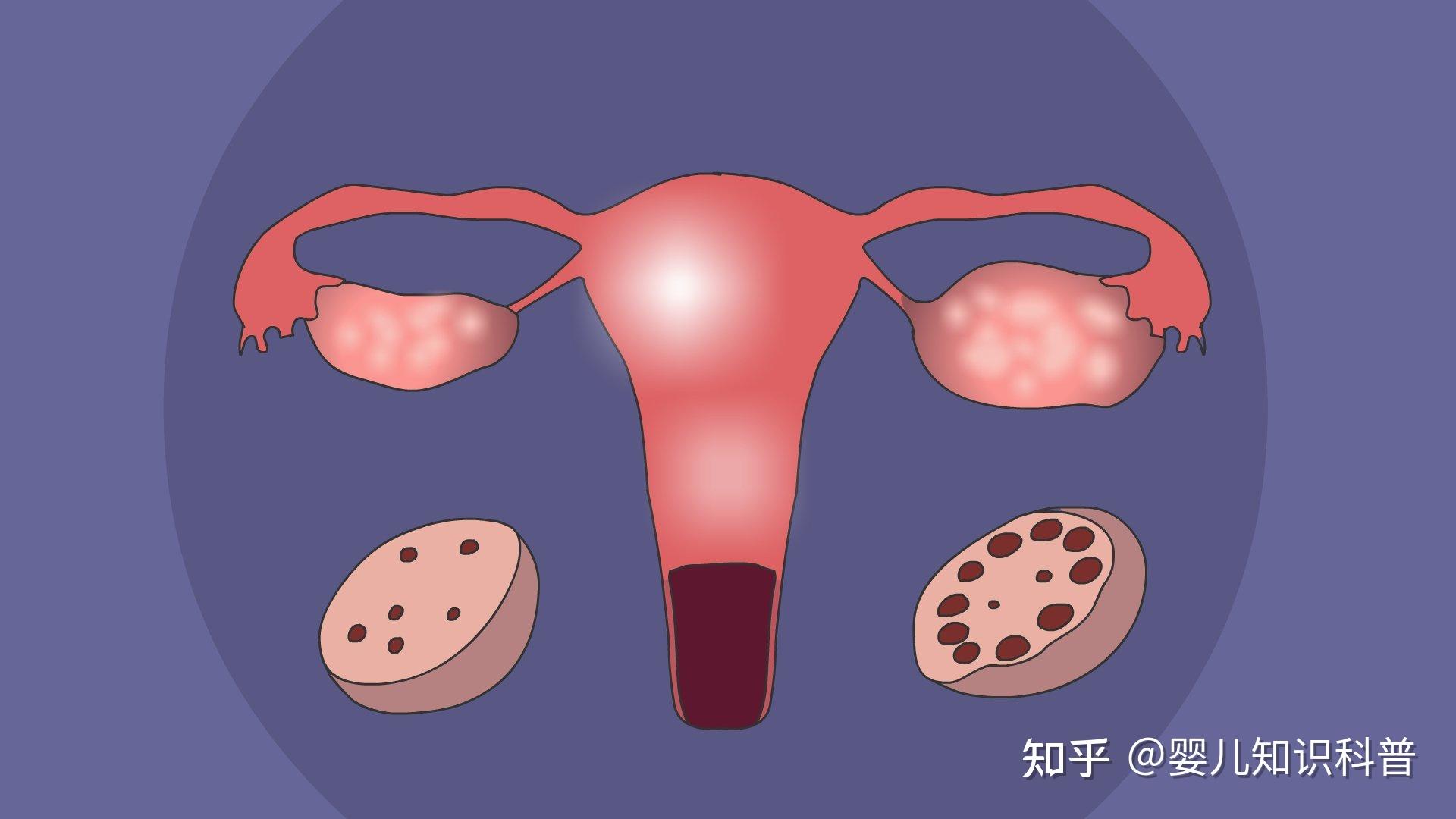 多囊卵巢综合症你们都是怎么治呀?
