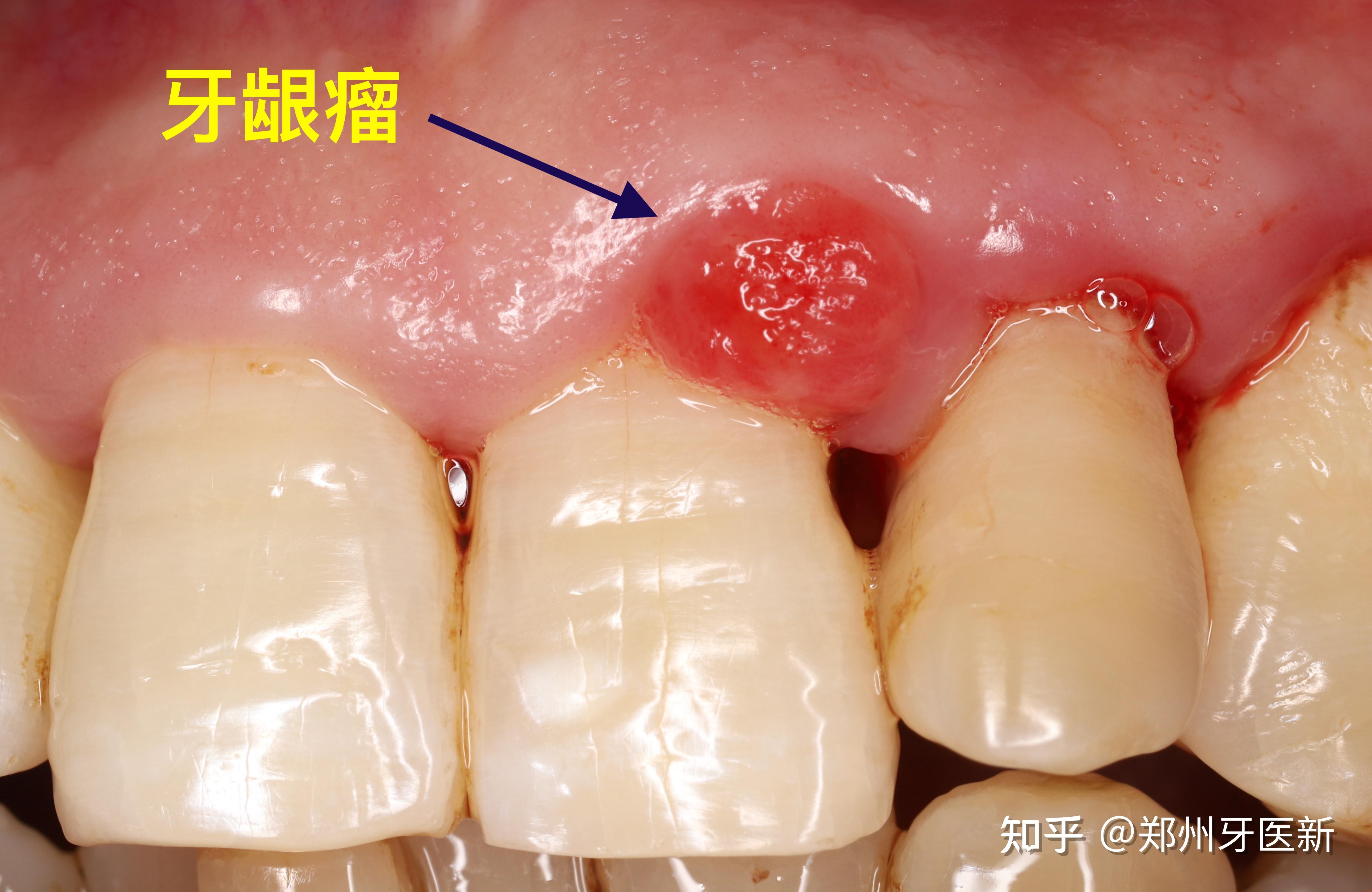 什么是牙龈瘤