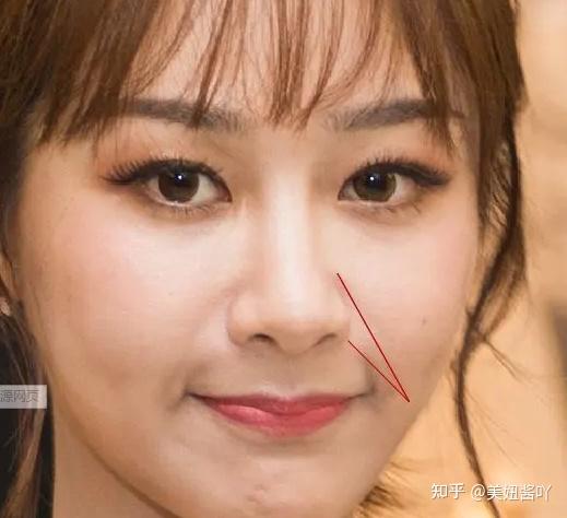为啥有人垫了鼻基底反而变丑了你真的适合垫鼻基底吗