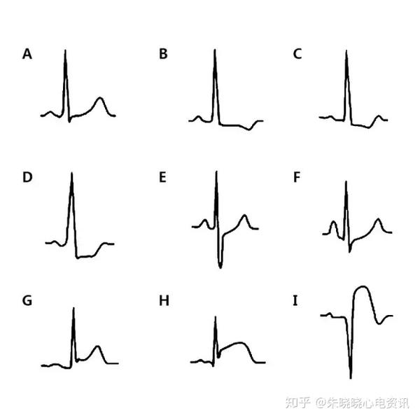 st段异常 zhuanlan.zhihu.com