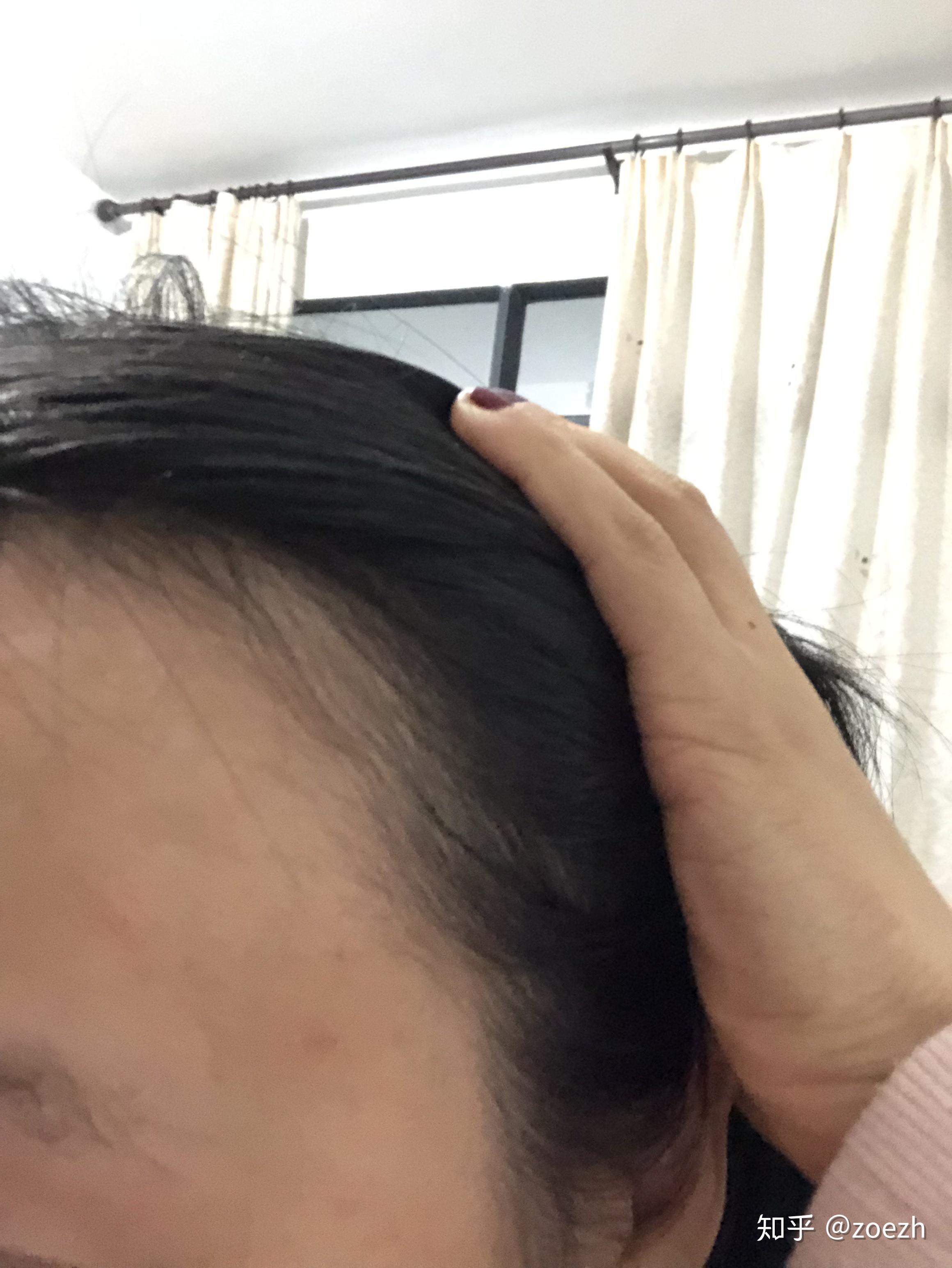 科普：脱发怎么办？严重脱发、发际线后移如何对症治疗？植发效果如何？ - 知乎