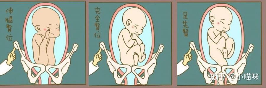 右骶前胎位图图片