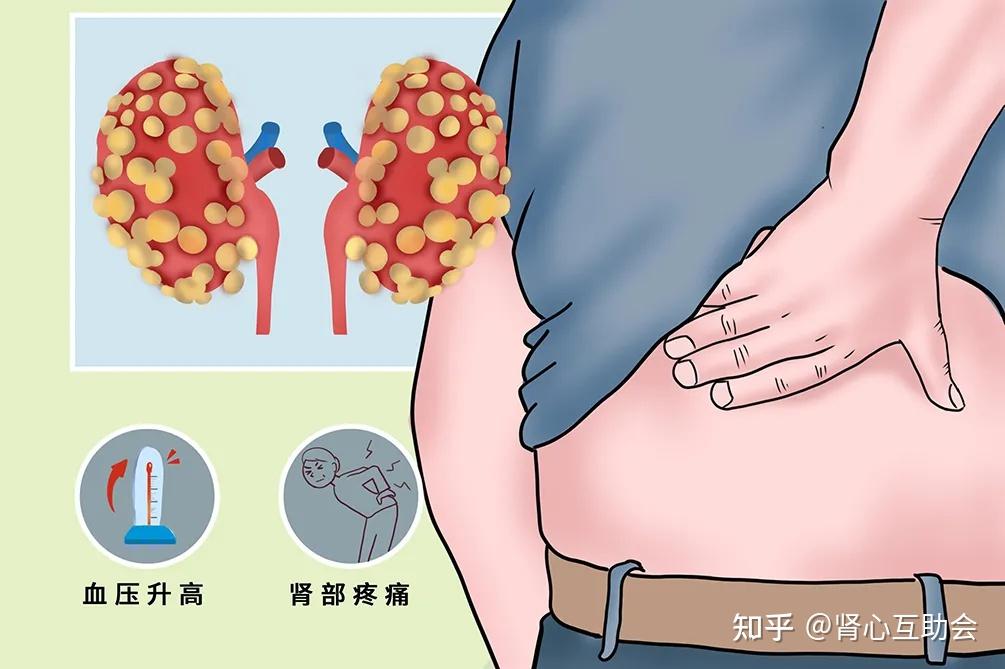 遗传性肾病 zhuanlan.zhihu.com