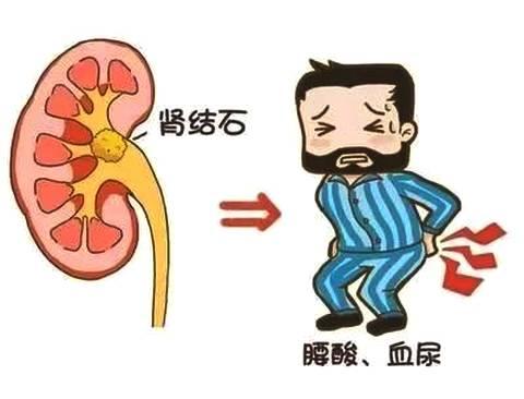 肾结石一般多久会疼 v2-2f77e57d605ab9b7c7cd0844616ae08b_1440w.jpg?source=172ae18b