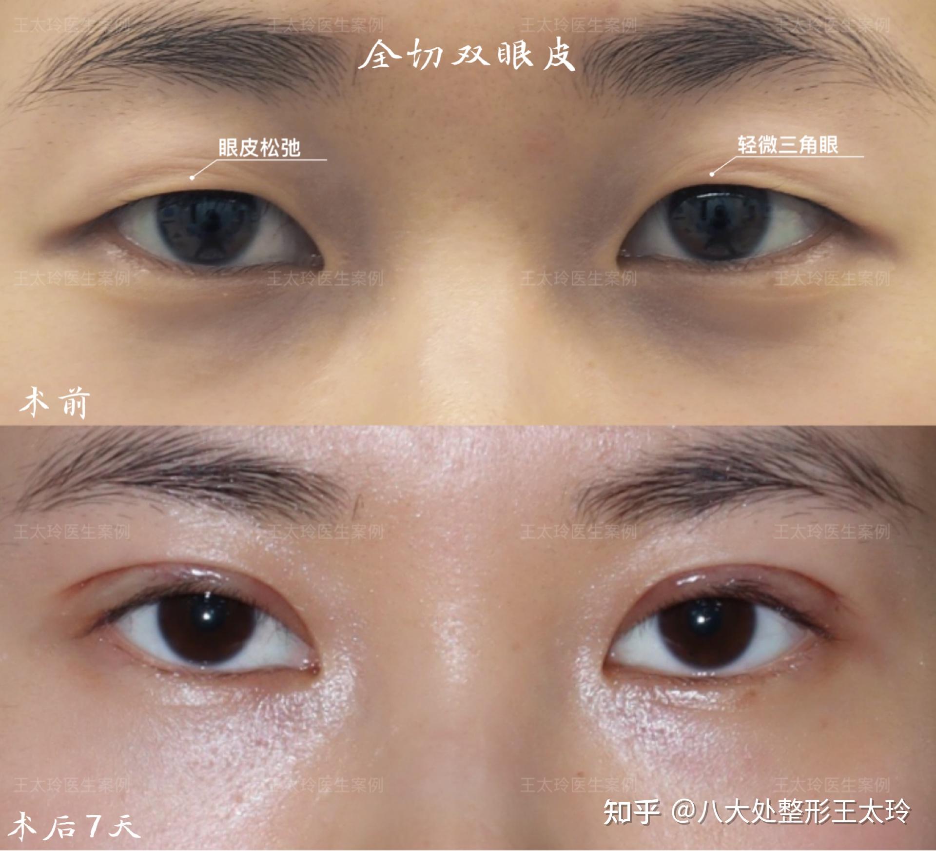 单眼皮,眼皮松弛,轻微三角眼,这种眼睛是非常适合做双眼皮调整的;【术