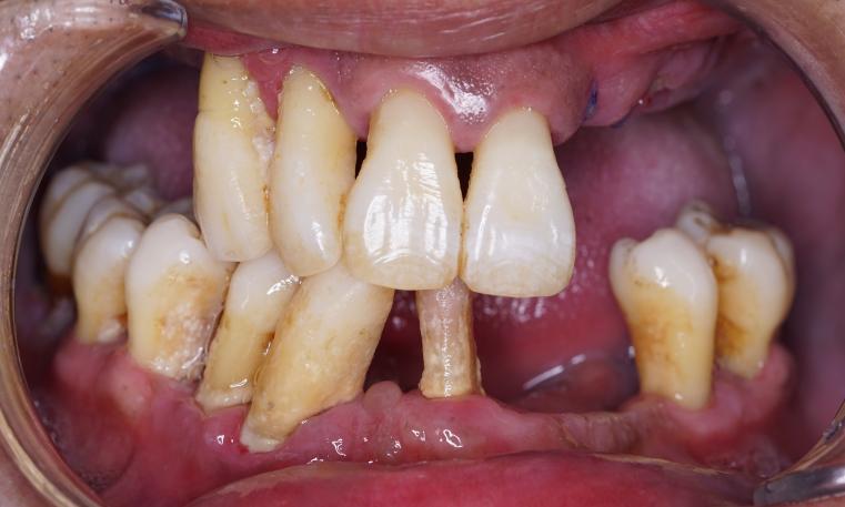 术前牙齿情况再给大家看下我爸之前的牙齿情况吧,前方高能,请各位不要