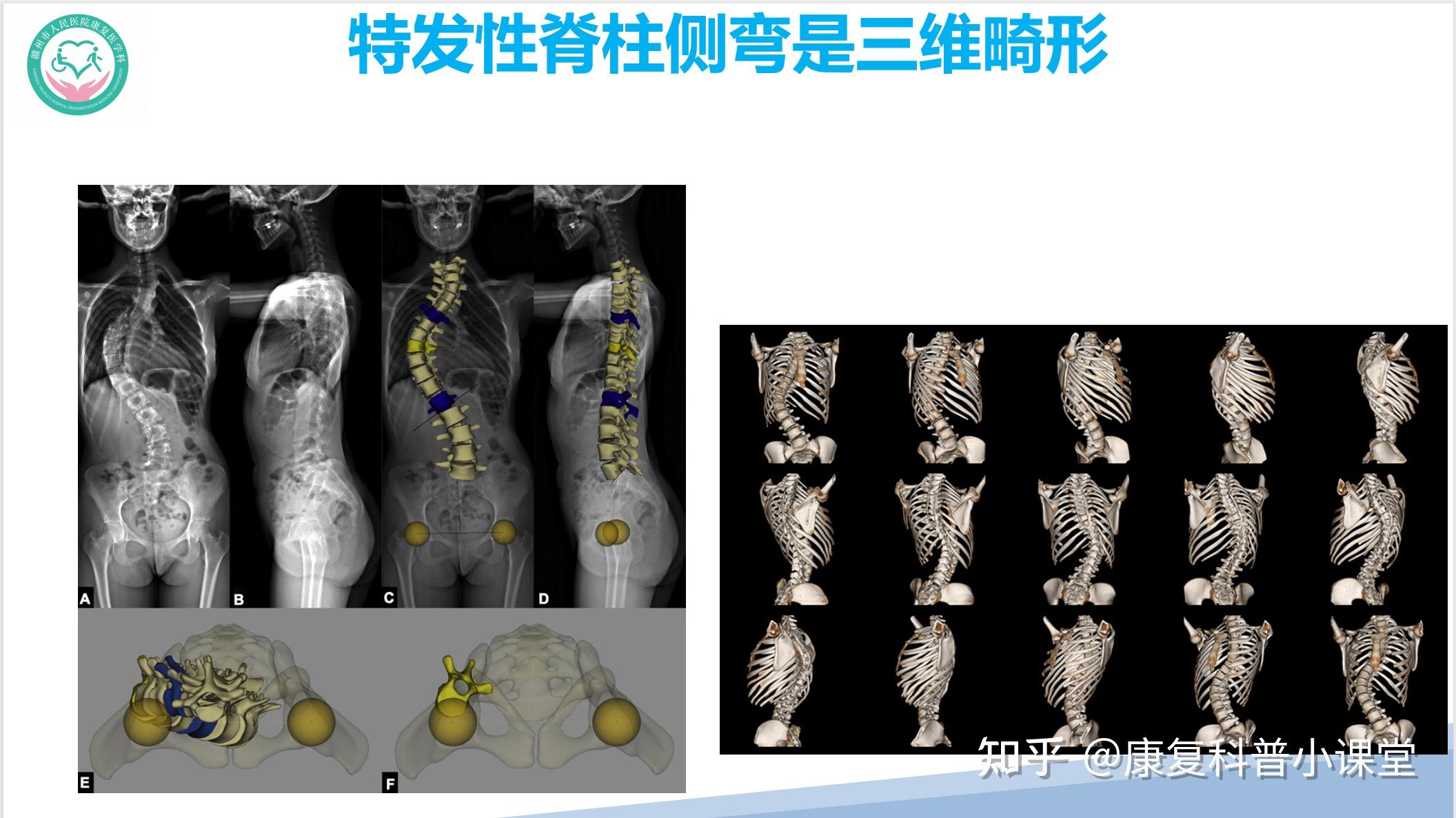 特發性脊柱側彎的診療策略