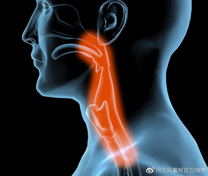 反流性咽喉炎的症状表现及治疗方法！ - 知乎